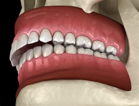 5 Common Overbite Treatment Options - NewMouth