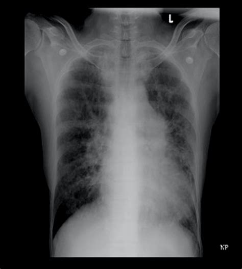 Bronchiolitis Chest X Ray