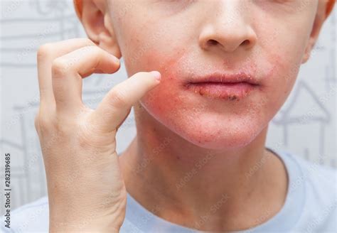 Boy Scratching His Face Human Skin Presenting An Allergic Reaction