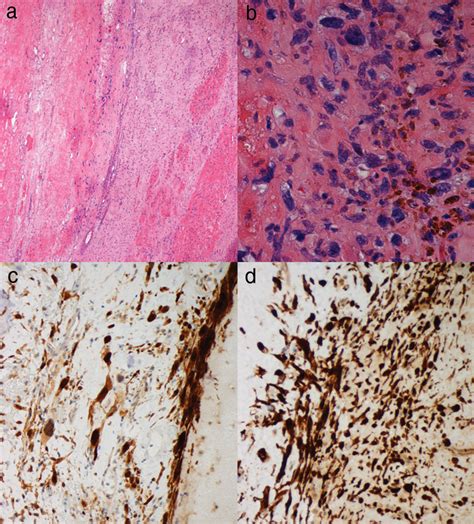 Microscopic Features Of The Pleural Liposarcoma A Low Power View Of