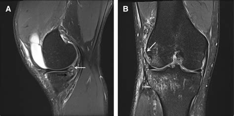 37-year-old male with acute ACL tear (not shown). A Sagittal ...