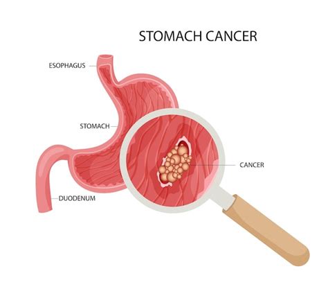 Cancer De L estomac Tumeur Cancéreuse Maligne Agrandie Sous Loupe