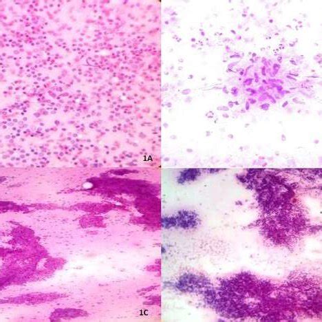 Reactive lymphadenitis showing polymorphous population of lymphoid ...