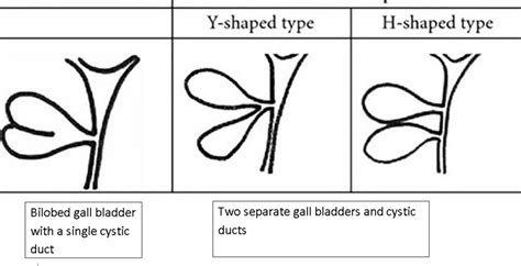 Bilobed Gallbladder A Rare Congenital Anomaly Bmj Case Reports