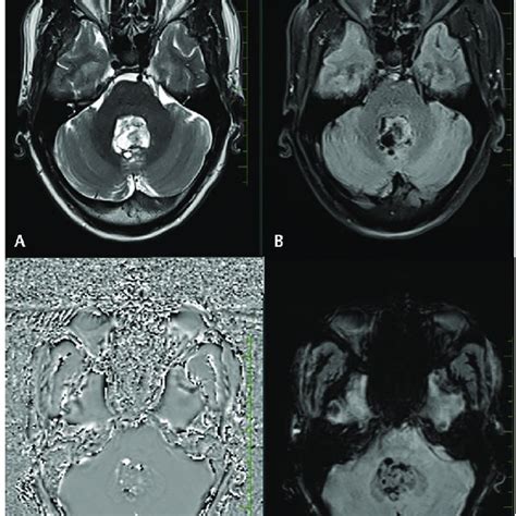 A Axial T2 Weighted And B Fluid Attenuated Inversion Recovery Image