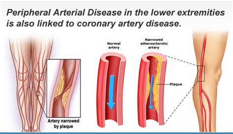 Peripheral Arterial Disease Screening Prevention