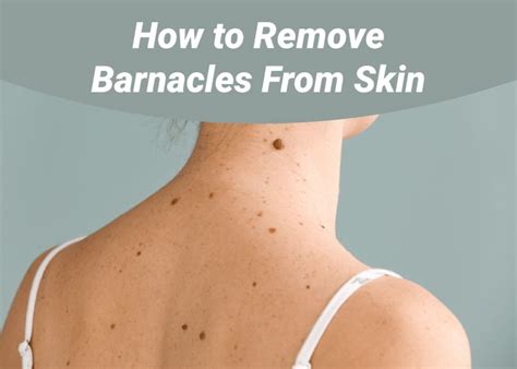 How to Remove Barnacles From Skin | Create your own story । Lifespeedsignup