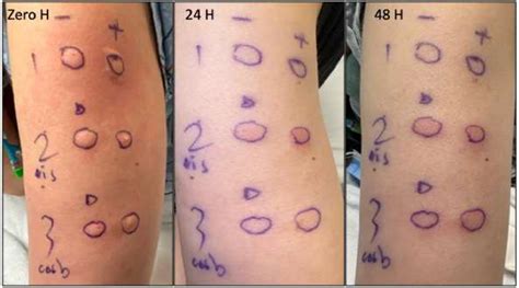 Intradermal Testing To Minimize Recurrence Risk Of Drug Reaction With Eosinophilia And Systemic