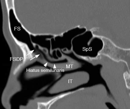 Frontal Sinus: Normal Anatomy & Variants