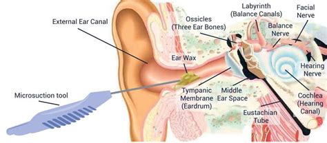 Ear Wax Removal Using Microsuction Clear Ears Clinic