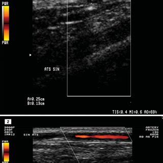 -ultrasound picture of "halo" sign in the superfi cial temporal artery ...