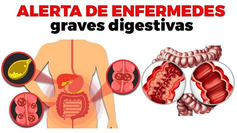 Sistema Digestivo Enfermedades Del Sistema Digestivo Porn Sex Picture