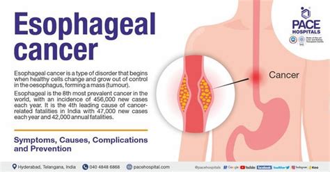 Esophageal Cancer Symptoms Causes Complications 44 Off