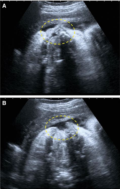 Figure From Prenatal Diagnosis And Management Of Van Der Woude