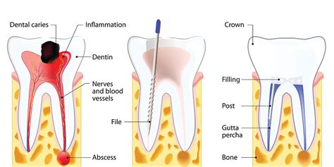 Root Canal Treatment Advantages And Disadvantages Shanti Dentals