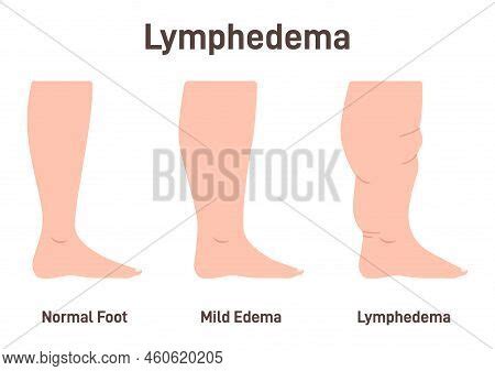 Lymphedema Stages. Vector & Photo (Free Trial) | Bigstock