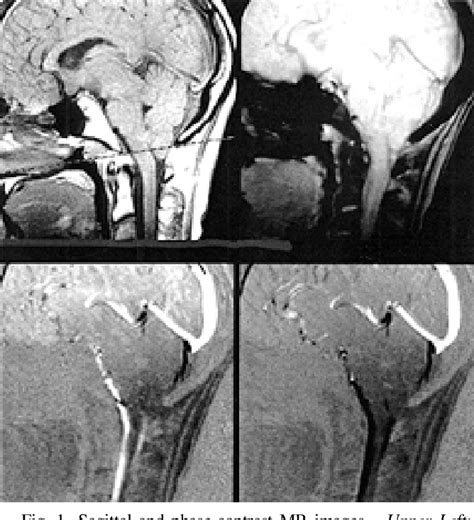 Figure From Phase Contrast Magnetic Resonance Imaging Of