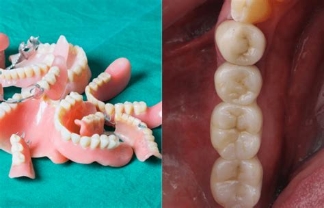 Permanent Bridge Vs Removable Partial Denture