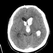 Intraventricular Hemorrhage Grades