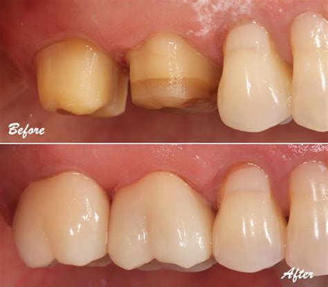 Decayed Molars Restored With Bonded Full Contour Zirconia Crowns Call