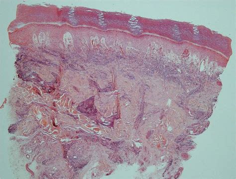 Chilblain Lupus (SLE pernio) - Dermatology Advisor