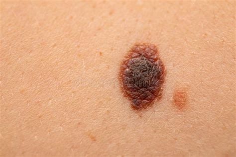 Dangerous Nevus On Skin Melanoma Stock Photo Image Of Female