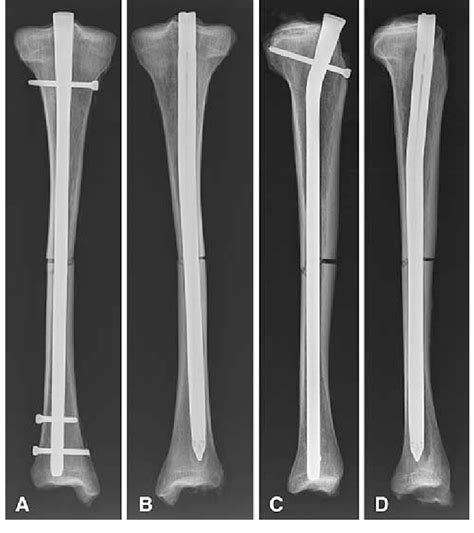 A D A B Anteroposterior And C D Lateral Radiographs Show The Download Scientific Diagram