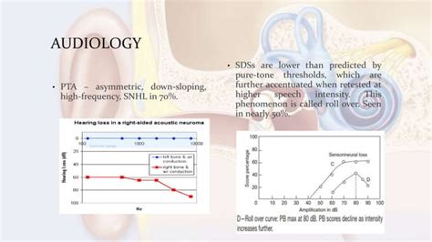 Vestibular schwannoma | PPT