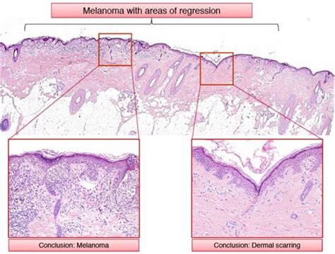 Racgp Skin Biopsy In The Diagnosis Of Neoplastic Skin Disease