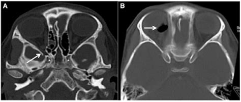 A Axial Ct Scan Showing Posterior Right Ethmoidal Lamina Papyracea