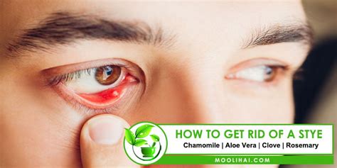 How To Get Rid Of A Stye Overnight Eye Stye Remedies Stye 56 Off