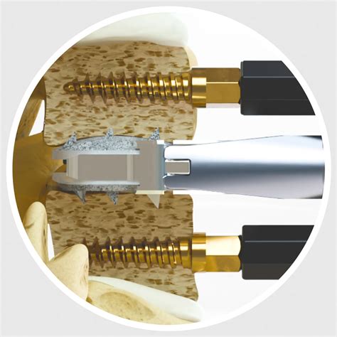 Centinel Spine For Prodisc Motion Preservation Disc Arthroplasty