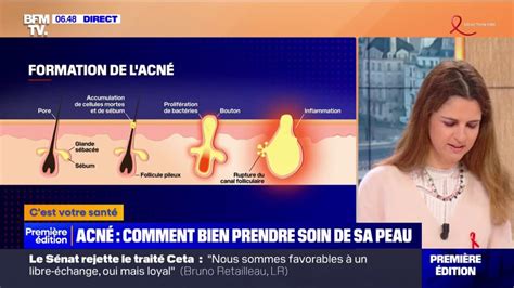 Comment Bien Prendre Soin De Sa Peau Quand On Souffre Dacné