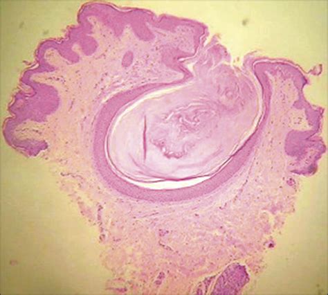 Childhood Flexural Comedones A New Entity Pediatrics Jama