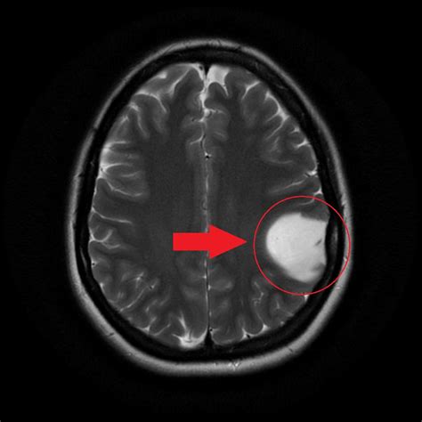 Astrocytoma MRI - wikidoc