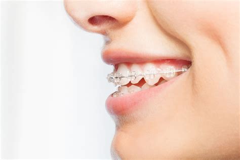 Invisible Braces Sydney Clear Aligners Smiles Unlimited