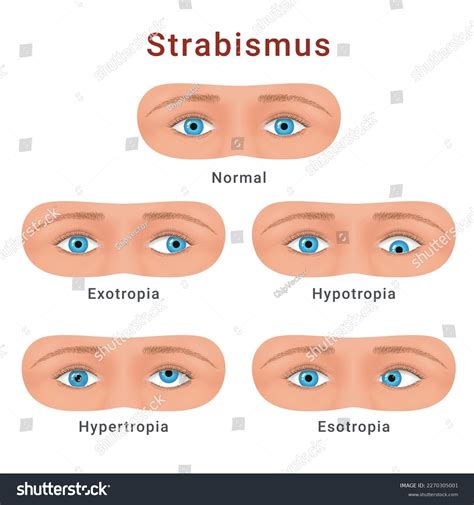 182 Exotropia Eye Images, Stock Photos & Vectors | Shutterstock