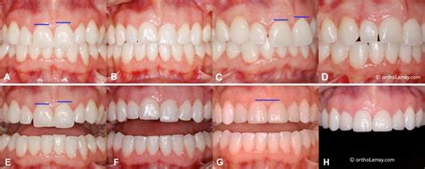 L Orthodontie Peut Aider Am Liorer L Esthtique Du Sourire