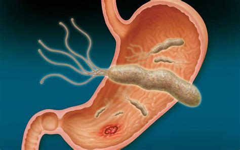 Helicobacter pylori sintomas Prevención y Tratamiento 2020