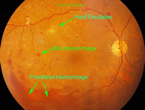 Flame hemorrhage vs dot blot hemorrhages - saadnest