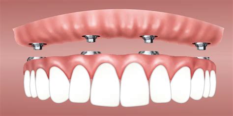 complete  partial dentures modern smile dentistry