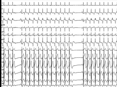 Twelve Lead Electrocardiogram At The Ep Lab Incessant Narrow Qrs Download Scientific Diagram