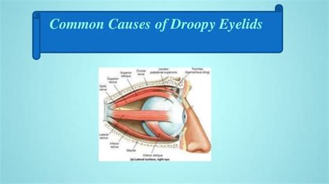 Causes and home remedies for droopy eyelids