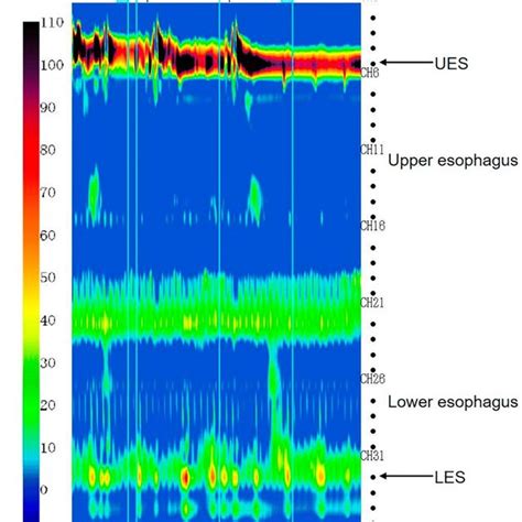 Esophageal High Resolution Manometry Esophageal Highresolution