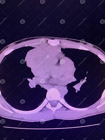 CT Scan Mass at Interior Mediastinum Stock Photo - Image of health, lower: 213470772