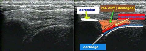 Ultrasound Of The Rupture Of Rotator Cuff