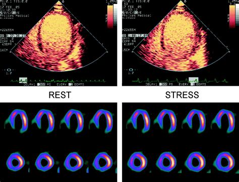 Myocardial Perfusion Imaging With Contrast Ultrasound Jacc