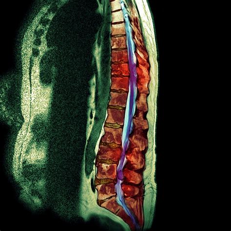 Secondary Bone Cancer Photograph by Simon Fraser/science Photo Library