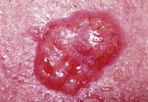 Basal Cell Carcinoma Vs Squamous Cell Carcinoma Bcc Vs Scc Costamedic