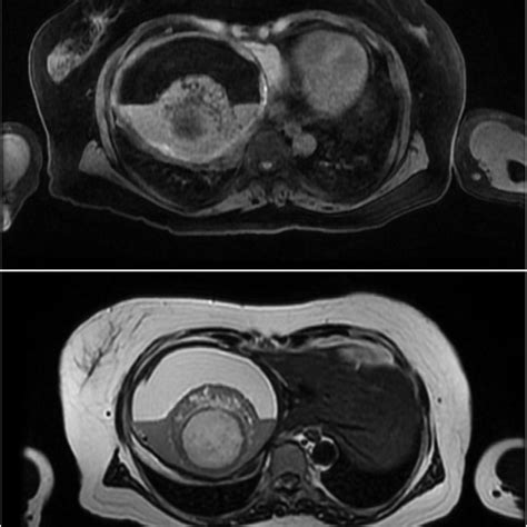 PDF Resection Of Ruptured Hepatic Teratoma In An Adult